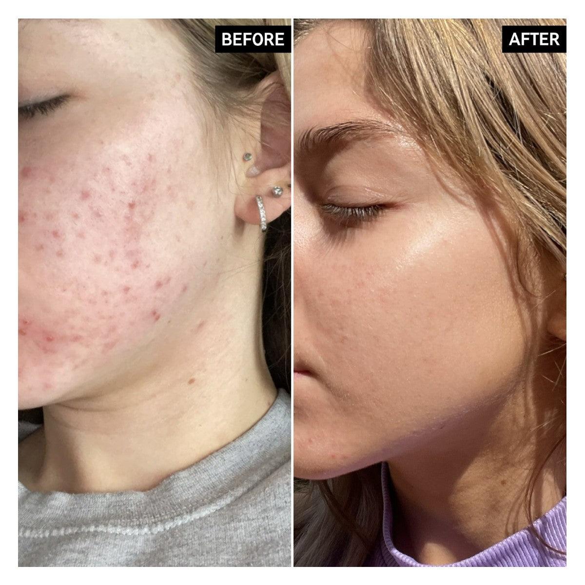 Oil Control Serum Control de Oleosidad de Niacinamida 30ml - The INKEY List - El Baúl de Mamá